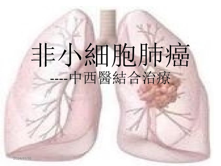 非小细胞肺癌_第1页