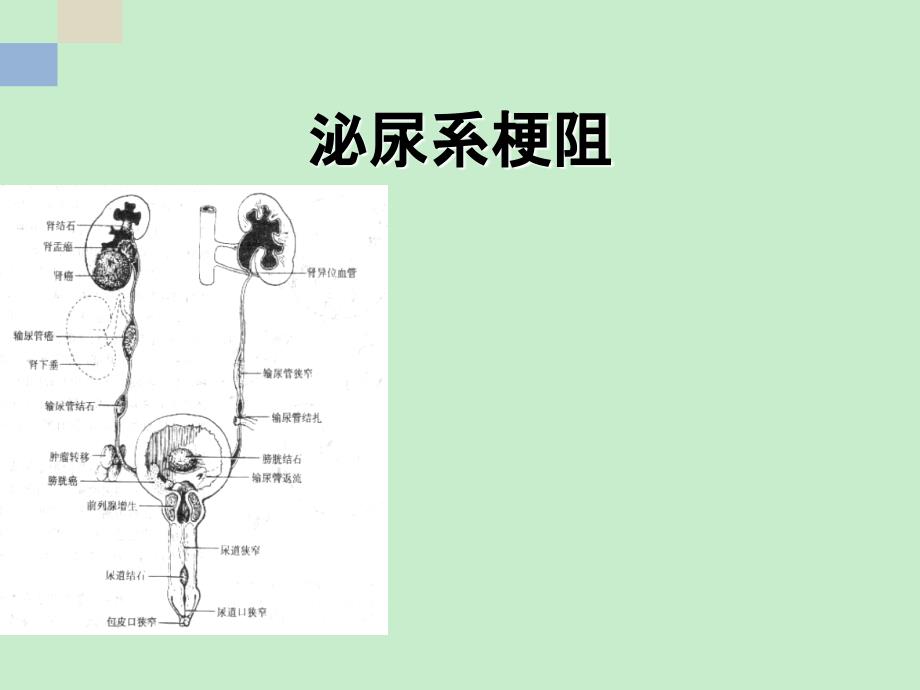 泌尿系梗阻_第1页