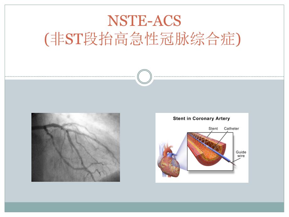 非ST段抬高性急性冠脉综合症_第1页