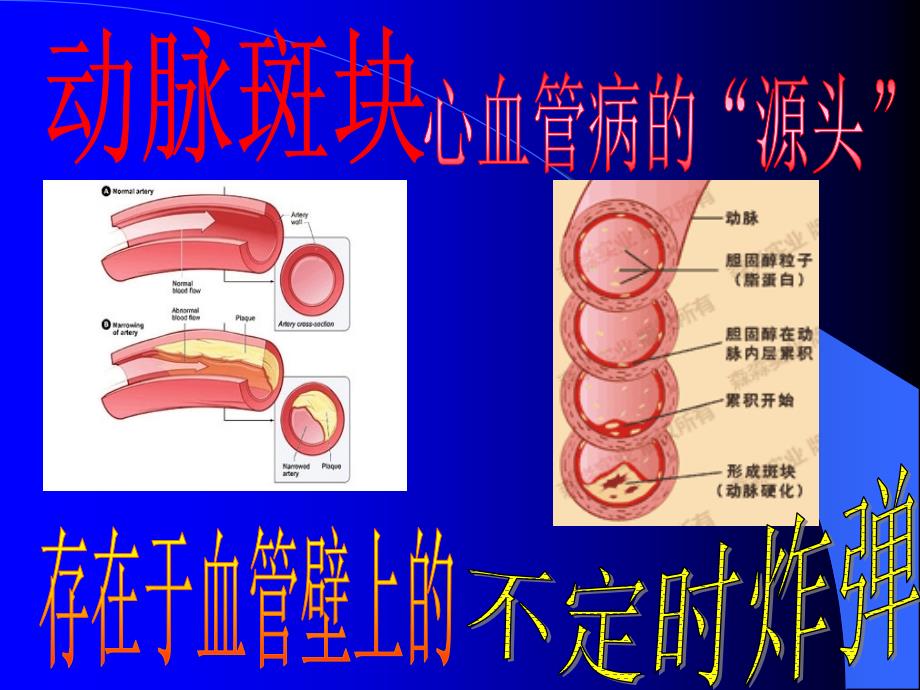 颈动脉斑块专题_第1页