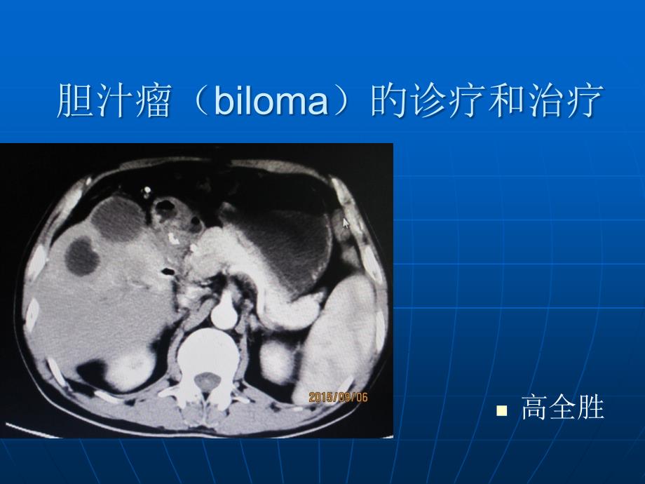 胆汁瘤biloma的诊断和治疗_第1页