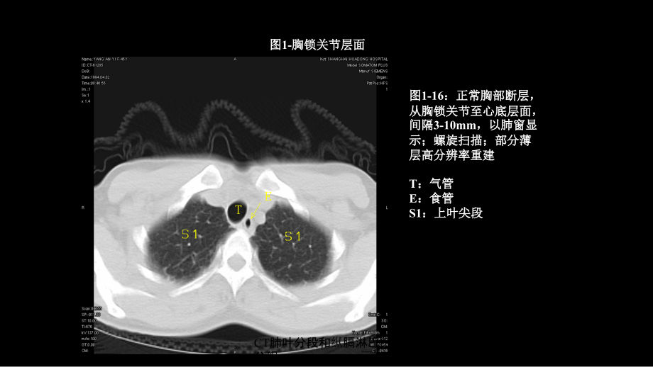 CT肺叶分段和纵膈淋巴结分组培训课件_第1页