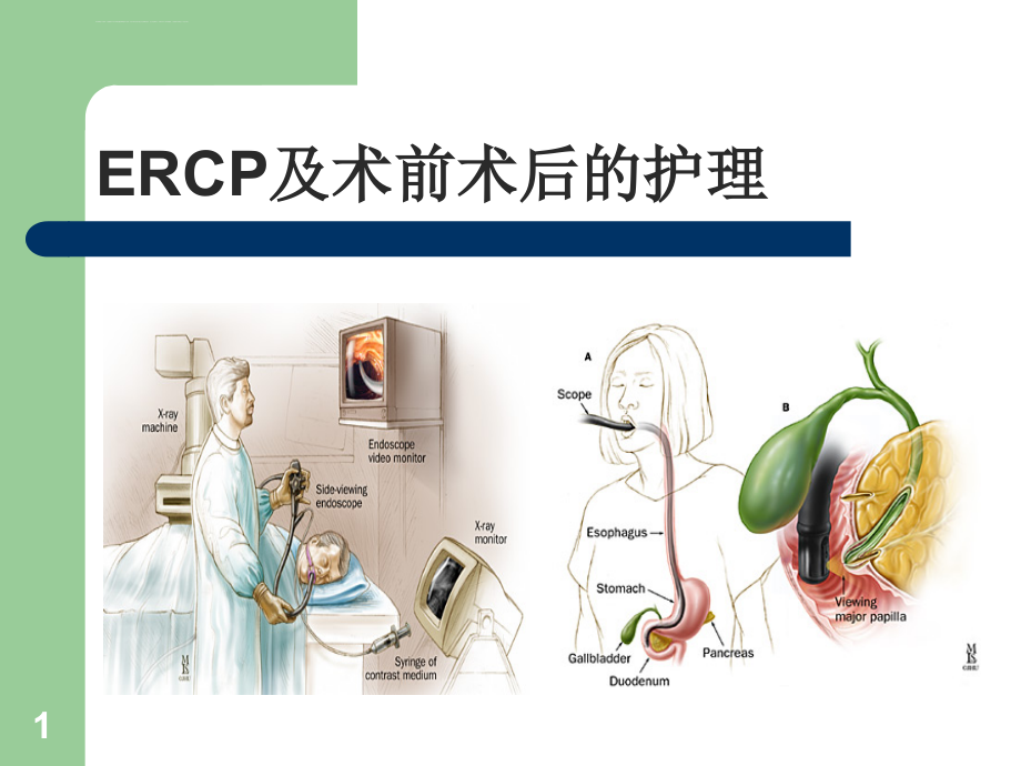 ERCP及术前术后护理ppt课件_第1页