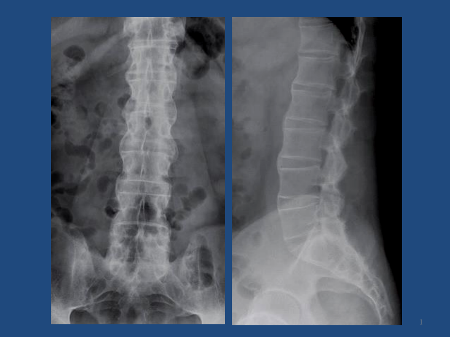 强直性脊柱炎(Ankylosing--Spondylitis-AS)课件_第1页