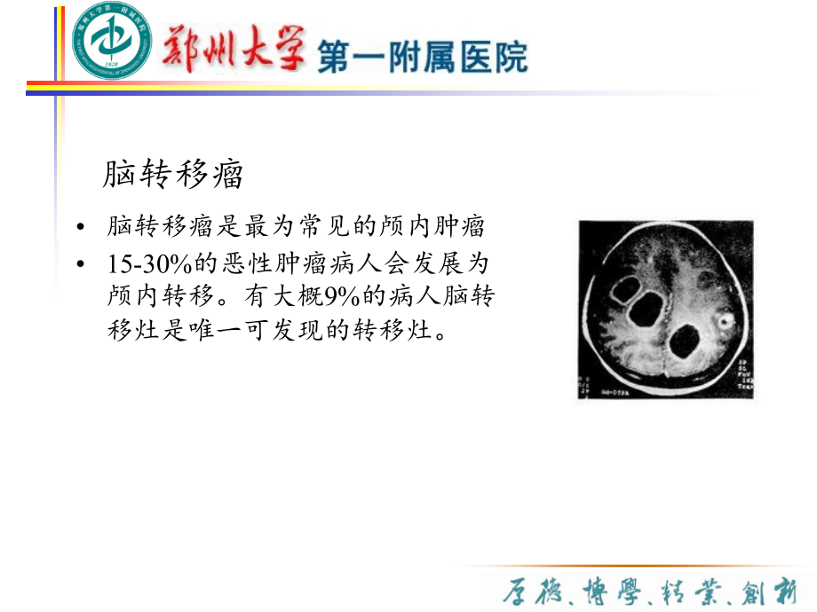 医学ppt课件脑转移瘤专业医学知识宣讲_第1页