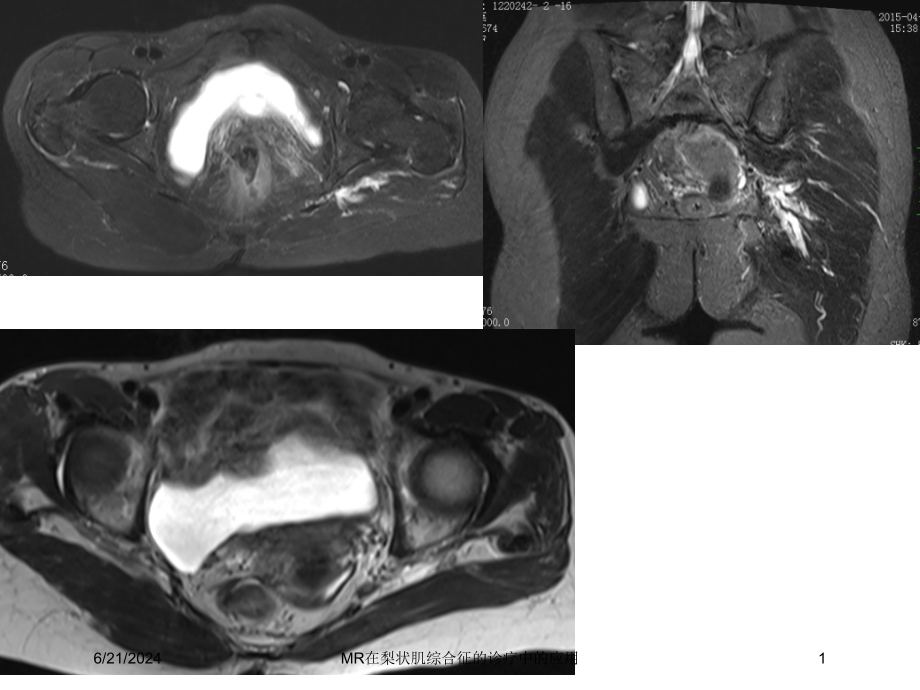MR在梨状肌综合征的诊疗中的应用培训ppt课件_第1页