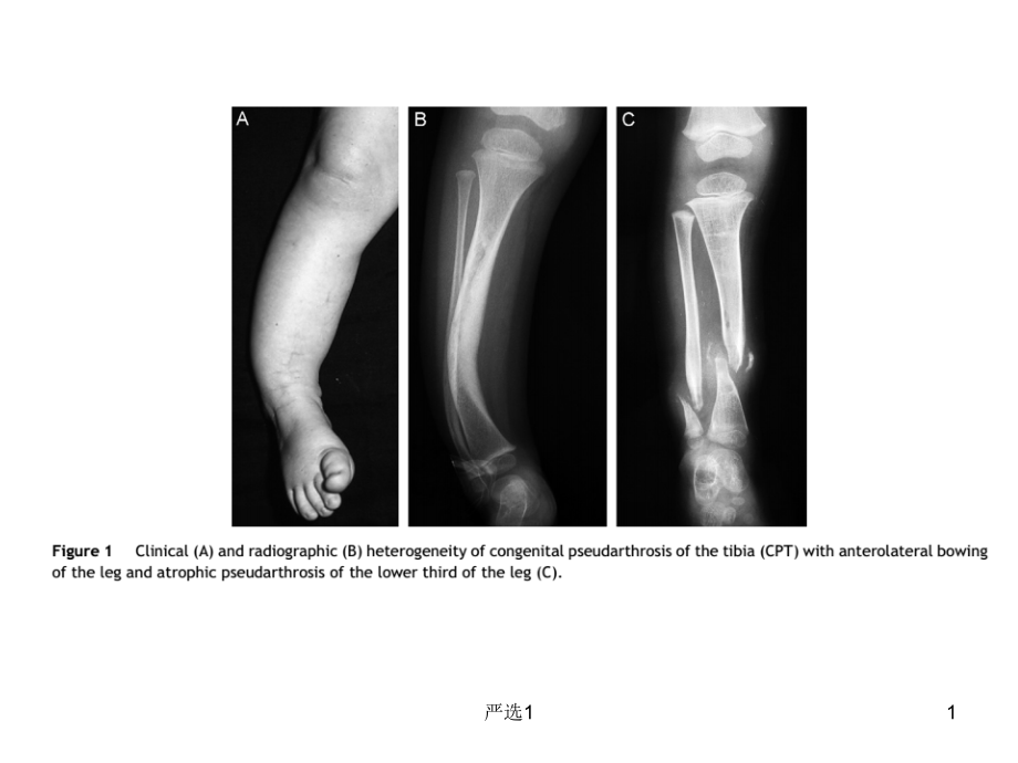 先天性胫骨假关节(医学技术)课件_第1页