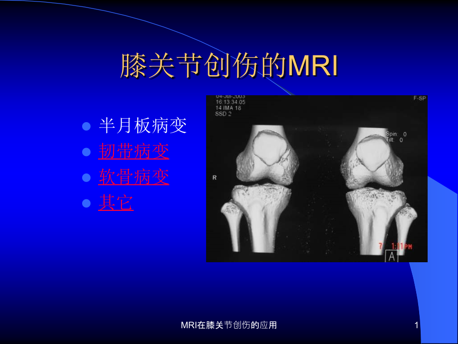 MRI在膝关节创伤的应用ppt课件_第1页