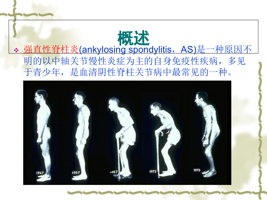 强直性脊柱炎SPARCC评分课件_第1页