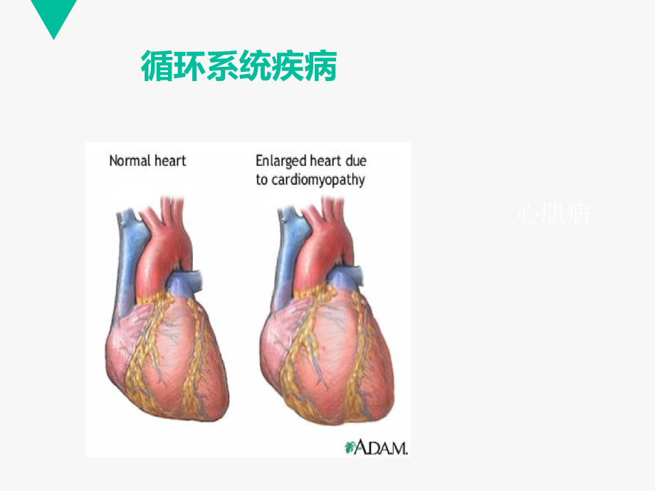 循环系统疾病【心肌病】--课件_第1页