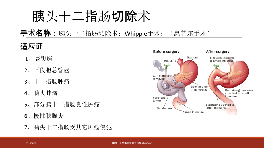 医学ppt课件胰腺指肠手术麻醉ABC_第1页