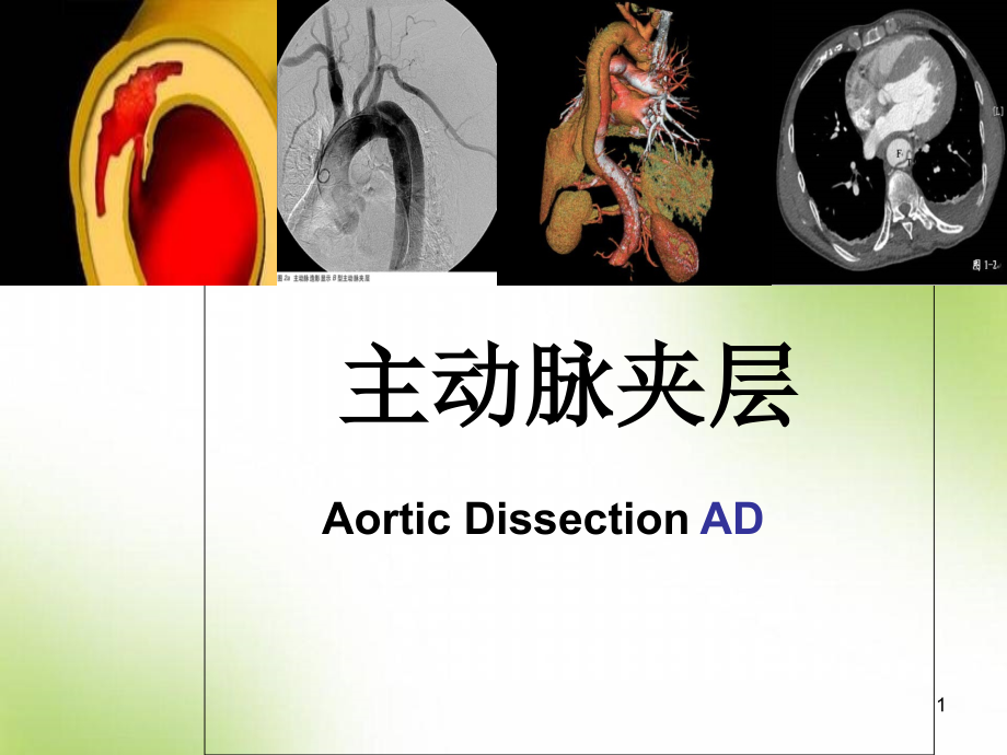 主动脉夹层医学ppt课件_第1页