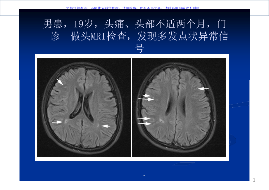 TCD发泡实验在神经内科疾病中应用的典型病例析ppt课件_第1页