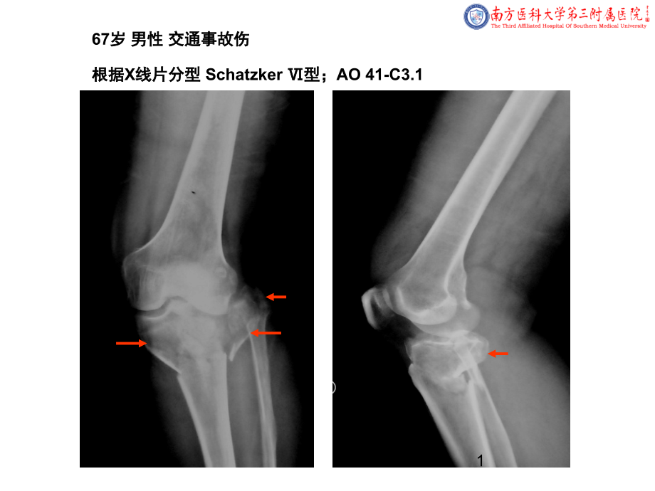 医学ppt课件外侧扩大入路治疗胫骨平台骨折_第1页