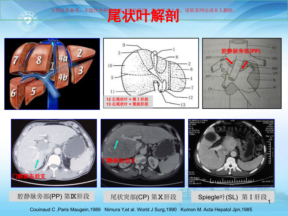 精准肝切除治疗尾状叶肝细胞癌经正中裂入路培训ppt课件_第1页