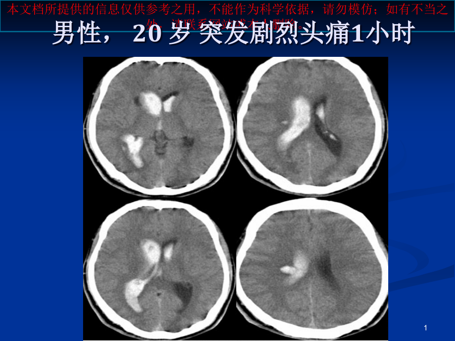 烟雾病影像诊疗培训ppt课件_第1页