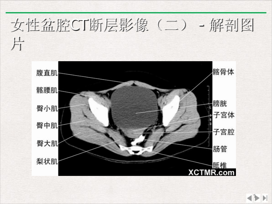 盆腔CT诊断版课件_第1页