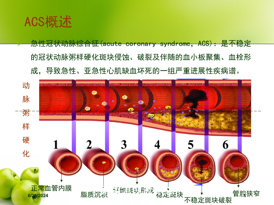 新版急性冠脉综合征的护理培训ppt课件_第1页