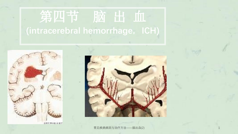 常见疾病病因与治疗方法——脑出血ppt课件_第1页