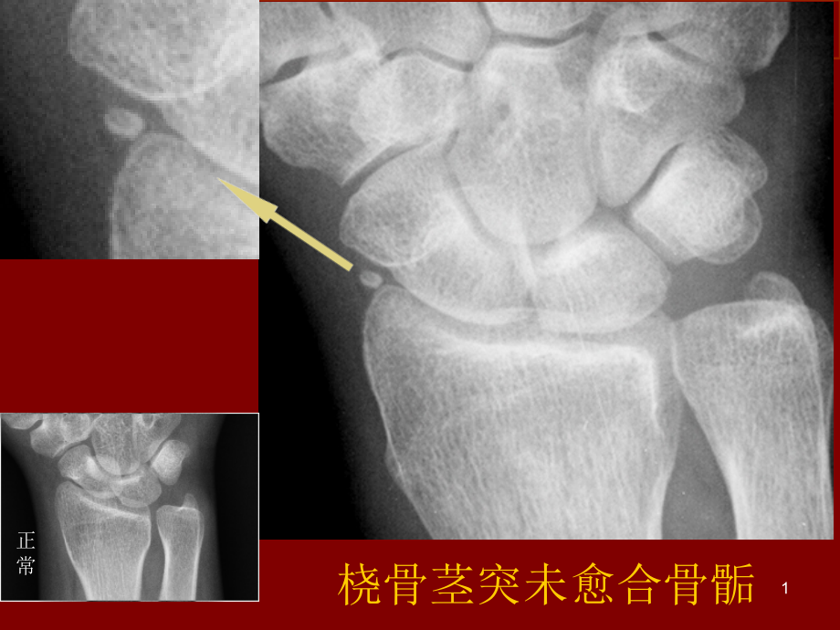 易误认为骨折的骨骺培训ppt课件_第1页