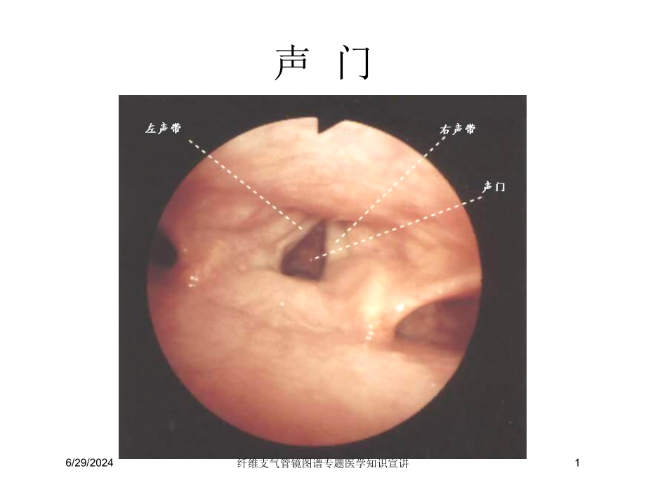 纤维支气管镜图谱专题医学知识宣讲培训ppt课件_第1页