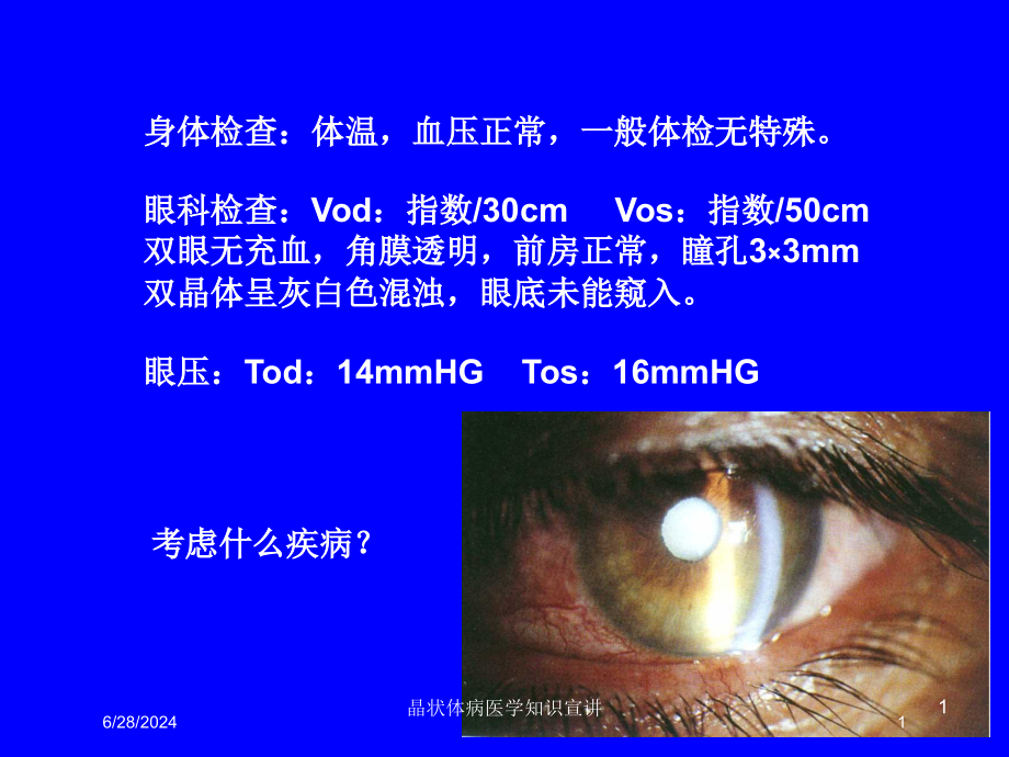 晶状体病医学知识宣讲培训ppt课件_第1页