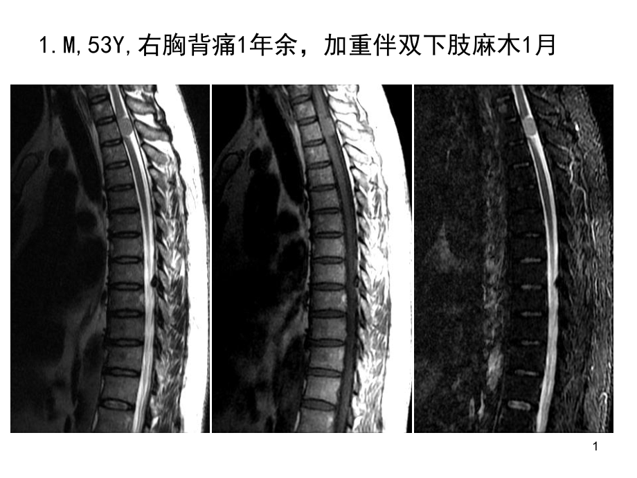 椎管髓外占位性病变影像诊断-课件_第1页