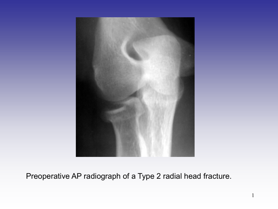 桡骨小头骨折切开内固定术课件_第1页