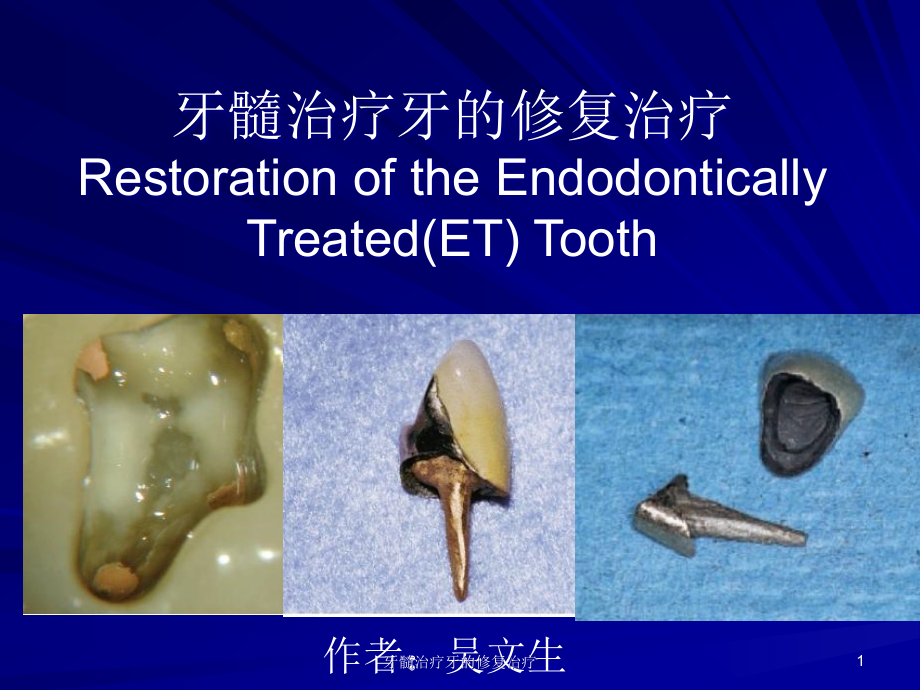 牙髓治疗牙的修复治疗ppt课件_第1页