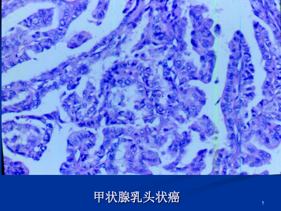 甲状腺疾病病理学课件_第1页