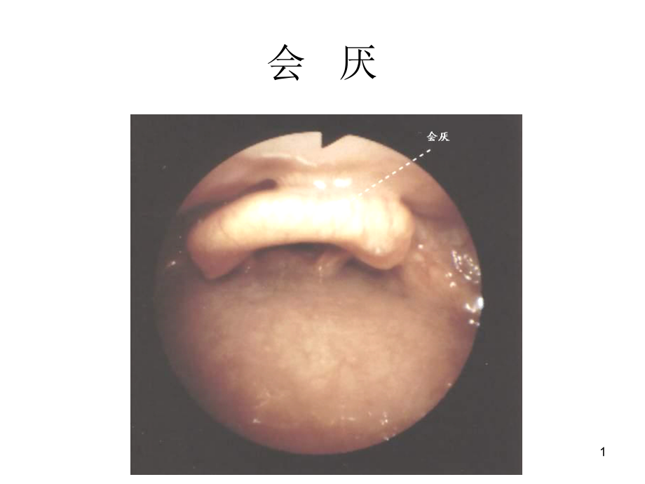 纤维支气管镜图谱课件_第1页