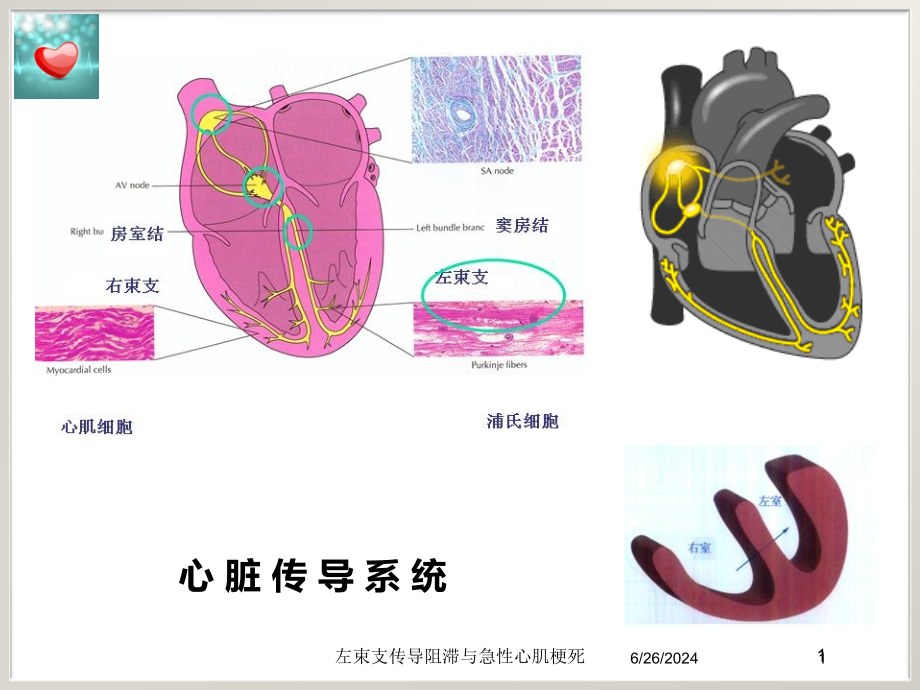 左束支传导阻滞与急性心肌梗死培训ppt课件_第1页