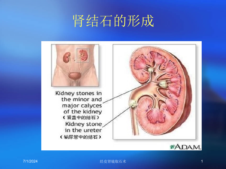 经皮肾镜取石术培训ppt课件_第1页