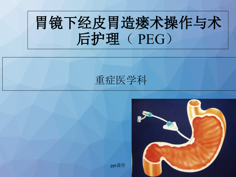 经皮胃镜下胃造瘘术操作与术后护理--课件_第1页