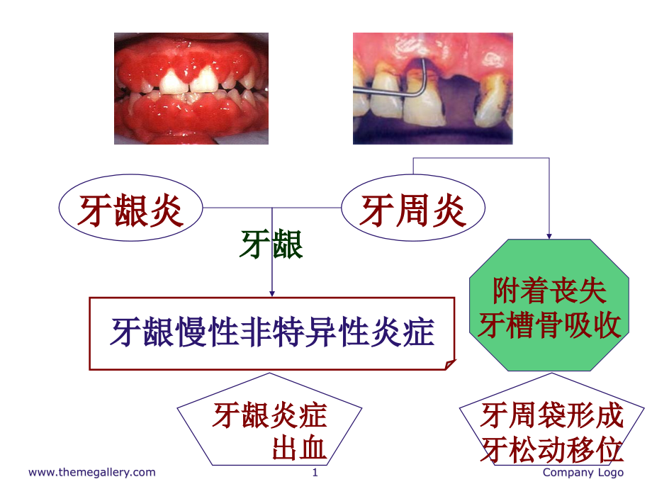 牙周病学牙周病的主要症状和临床病理课件_第1页