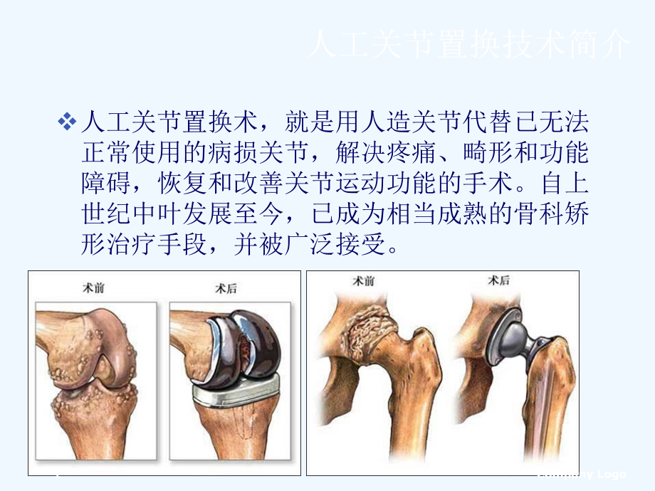 康复治疗在人工关节置换术治疗中的进展及发展方向课件_第1页