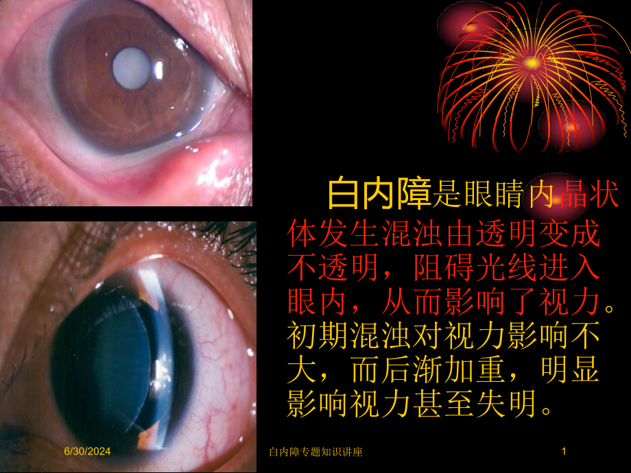 白内障专题知识讲座培训ppt课件_第1页