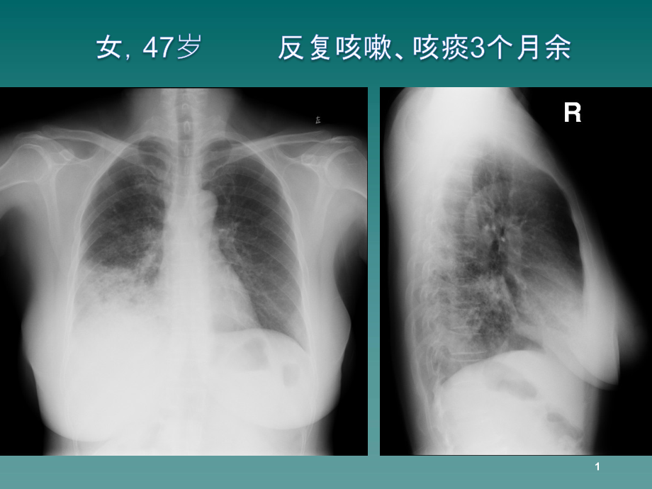 浸润型黏液性腺癌培训 医学ppt课件_第1页