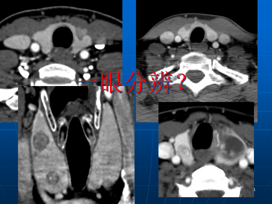甲状腺乳头状癌CT征象课件_第1页