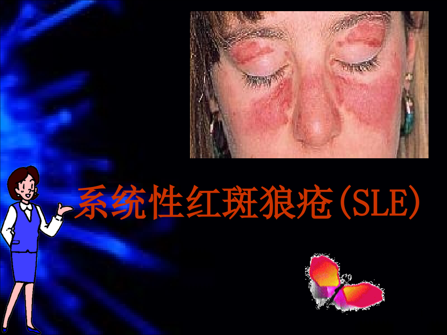 系统性红斑狼疮(SLE)课件_第1页