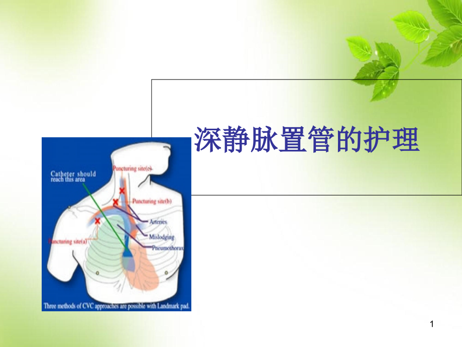 深静脉置管的护理培训 医学ppt课件_第1页