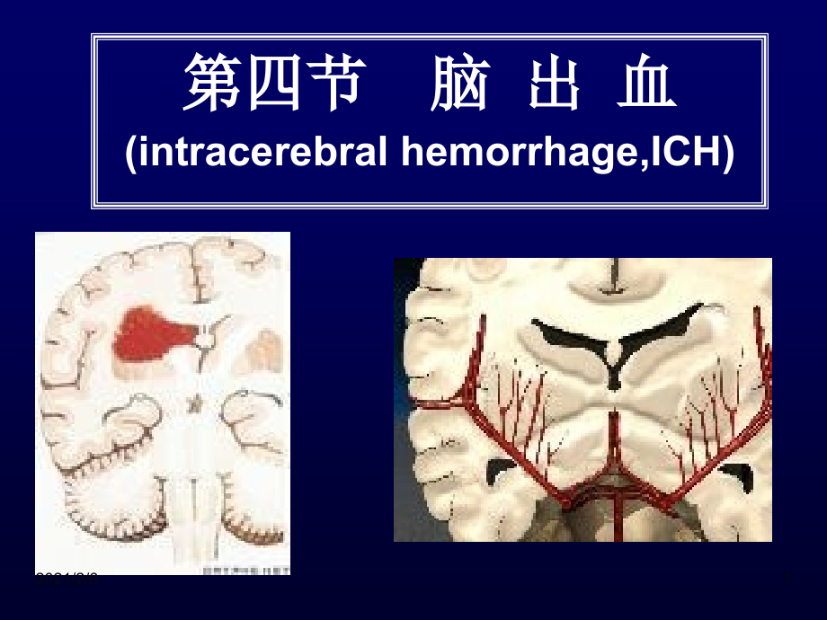 常见疾病病因与治疗方法——脑出血课件_第1页