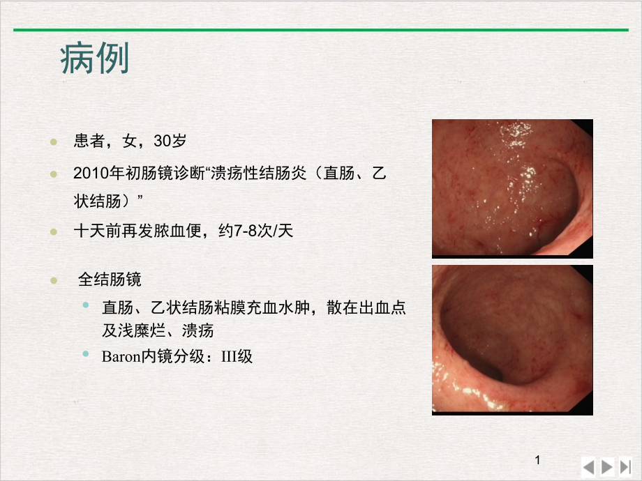 溃疡性结肠炎治疗规范课件_第1页