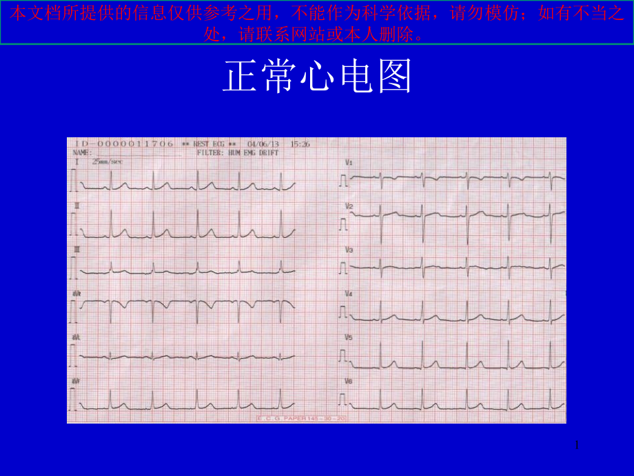 心律失常心电图表现培训ppt课件_第1页