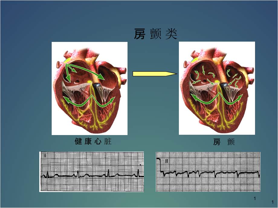 房扑与房颤心电图医学课件_第1页