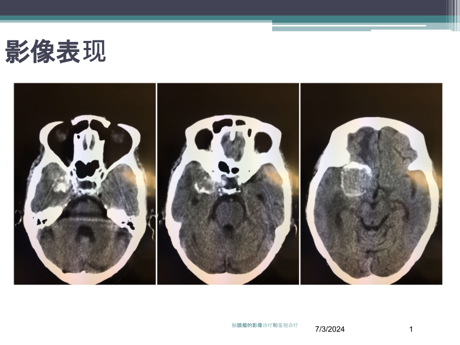 脑膜瘤的影像诊疗和鉴别诊疗培训ppt课件_第1页