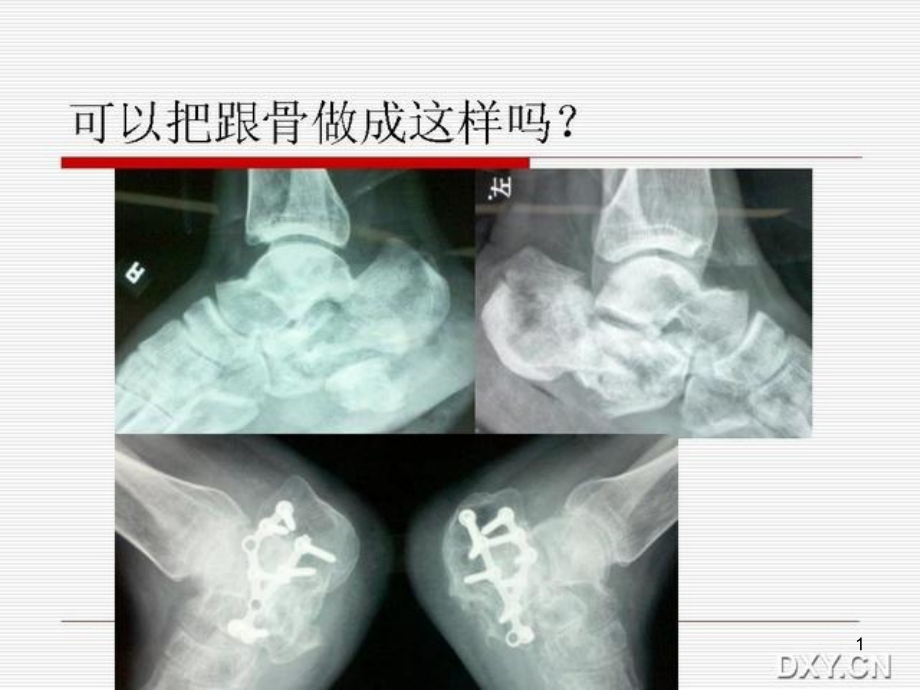 跟骨骨折复位课件_第1页