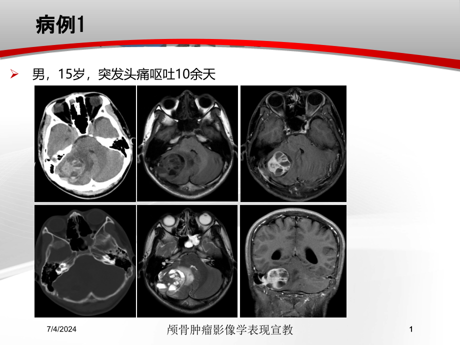 颅骨肿瘤影像学表现宣教培训ppt课件_第1页