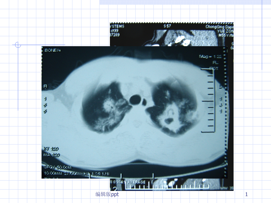 肺部CT及X线诊断基础课件_第1页