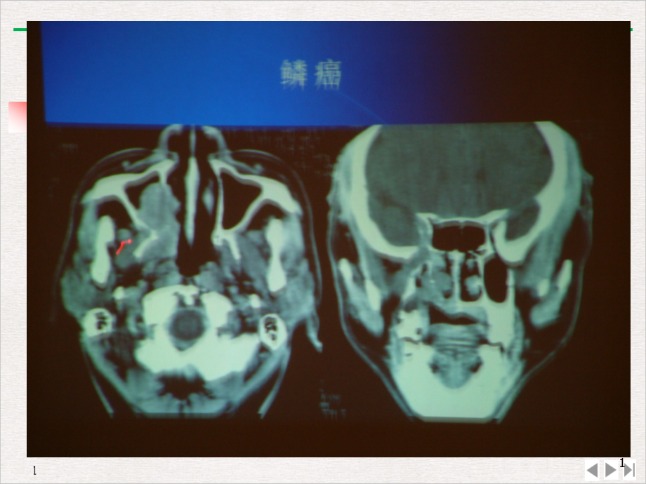 鼻腔鼻窦的恶性肿瘤完美课课件_第1页